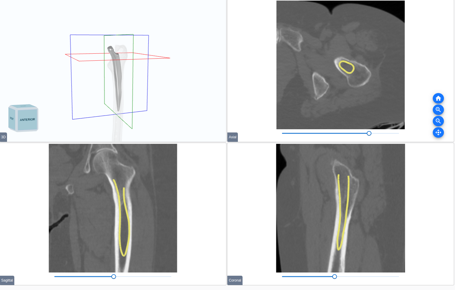 3D CT planning for hip implants